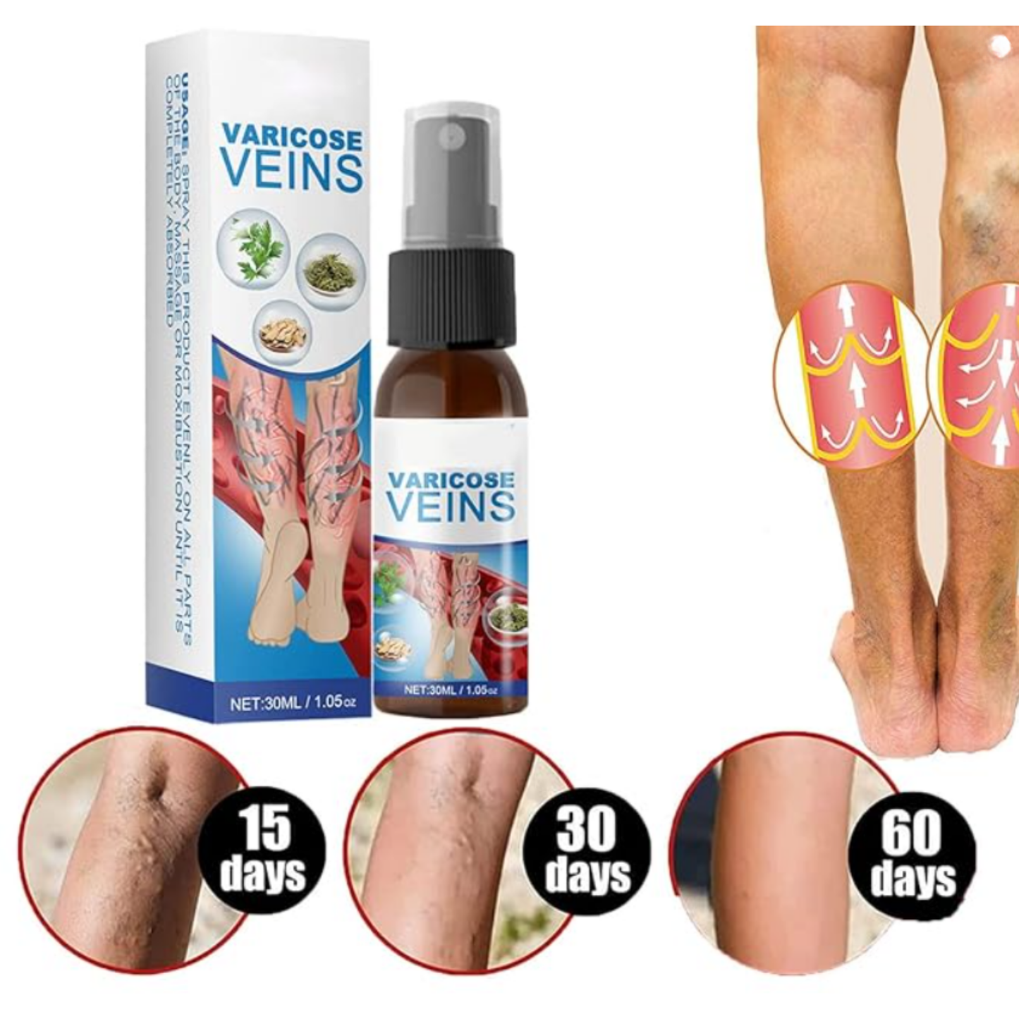 Varicose Veins™ | Recupera La Belleza En Tus Piernas.