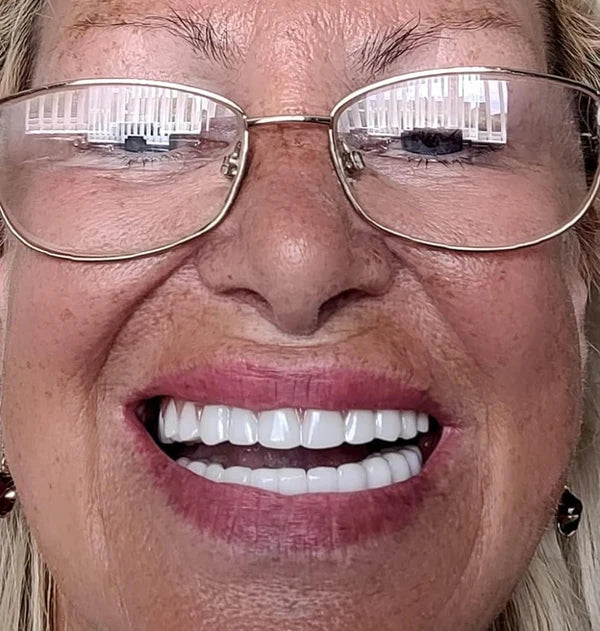 SNAP ON SMILE™ | DISEÑO DE SONRISA INSTANTÁNEO