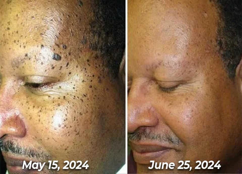 TagRecede™ | Elimina Verrugas, Manchas Y Lunares. (OFERTA 2X1) 🎁