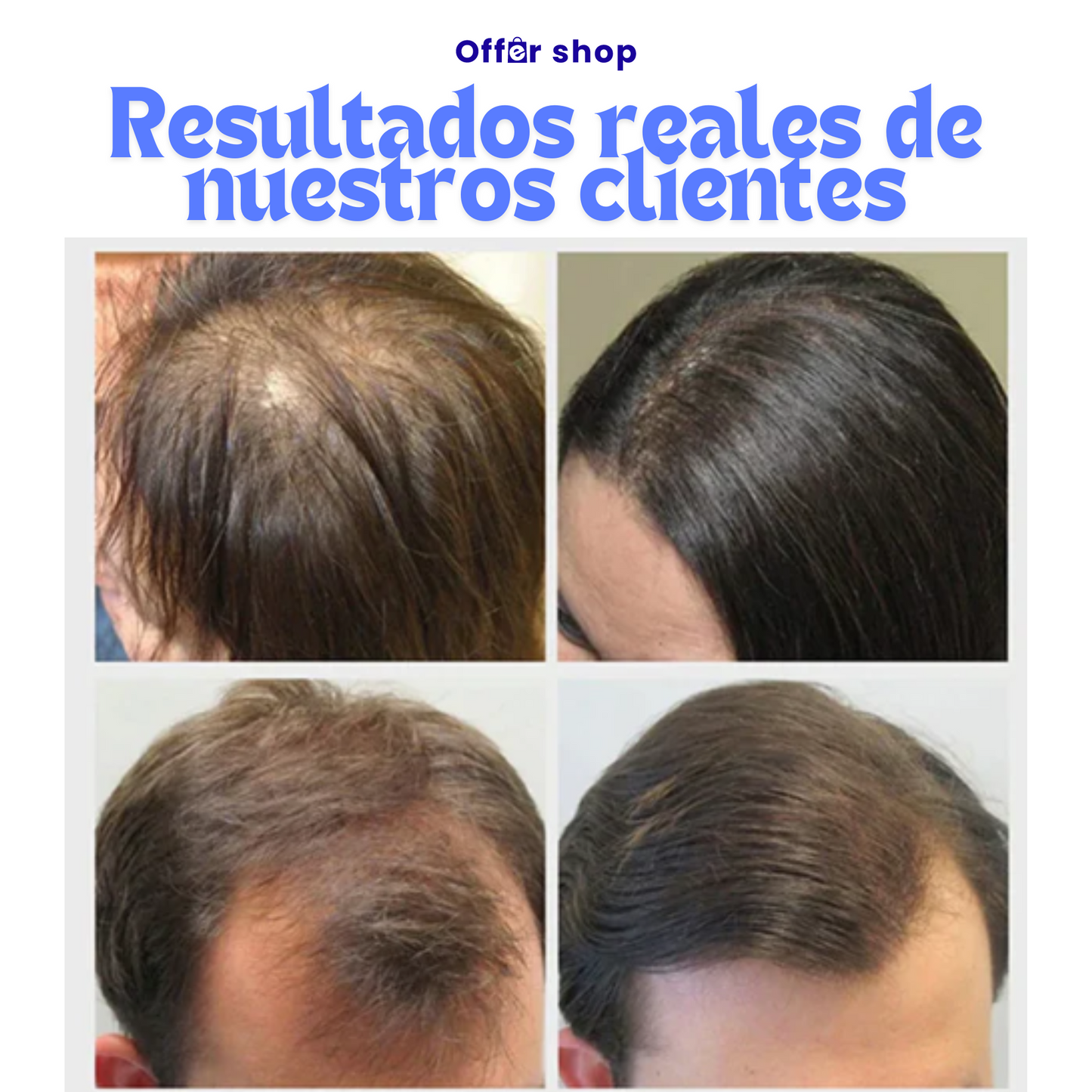 KING OF GINGER™ | Mega Pack X3 Tratamiento Completo - Resultados A Partir Del Día 7.